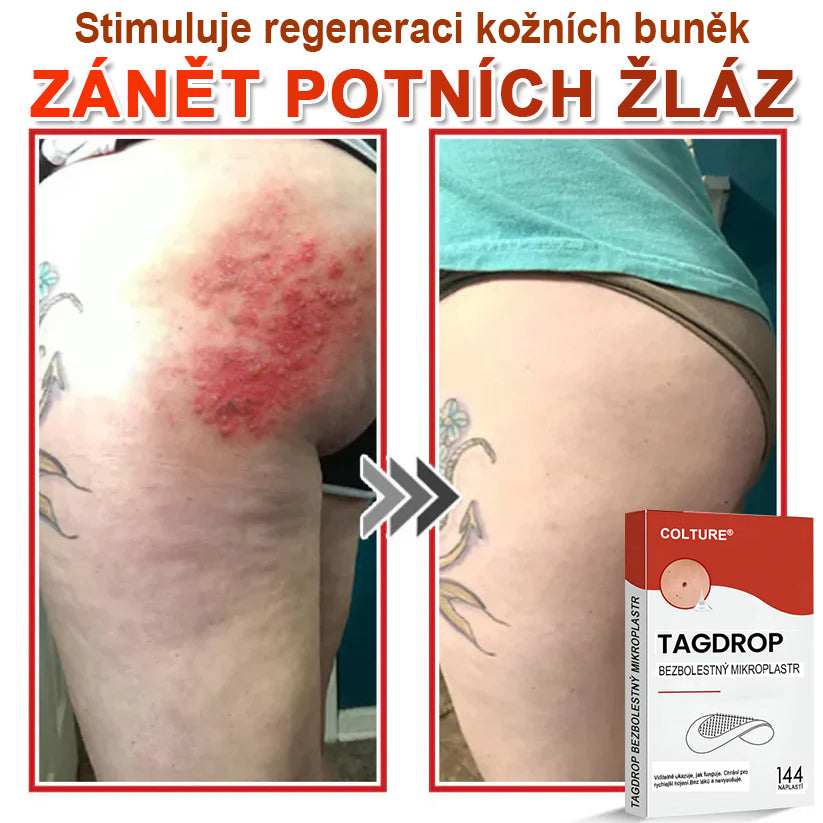 COLTURE® Mikrovpichová botanická náplast na odstranění kožních výrůstků