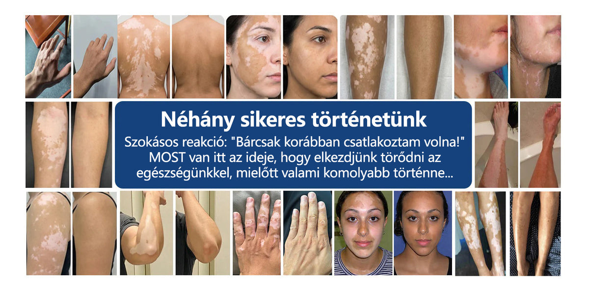 CleraNaure® Piperine Repigment Aktivátor Spray, amely aktiválja a lappangó pigmentsejteket, és visszaállítja a természetes bőrszínt.