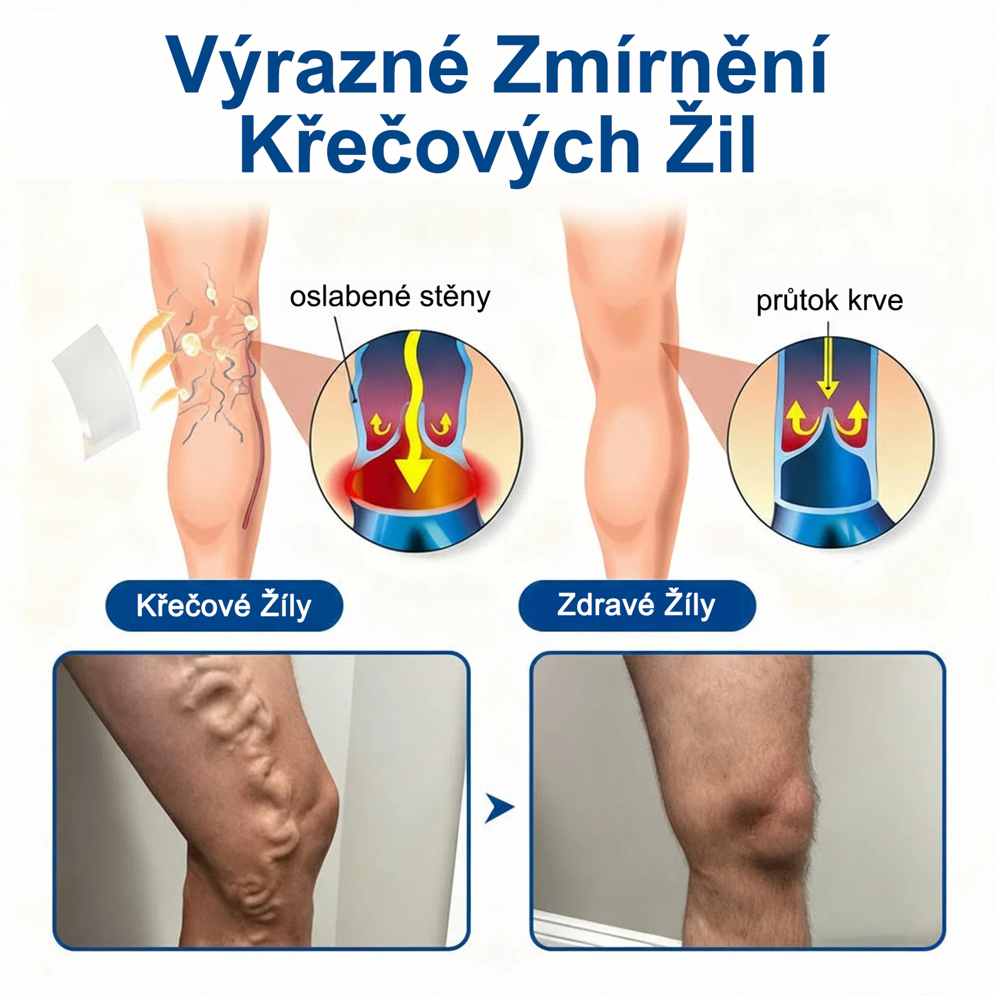 FLORISMA® Klinická mikrojehličková náplast s diosminem a hesperidinem🌿 – zaměřená na křečové a metličkové žilky, pomáhá zmírnit pocit těžkých a unavených nohou