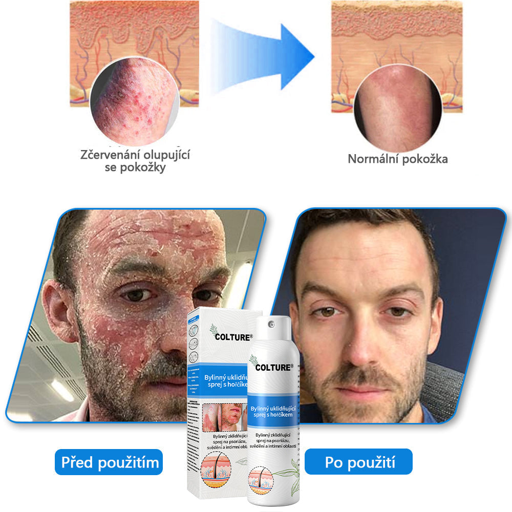 ✅COLTURE® Magnesium bylinný sprej ⚕️ Certifikace MHRA – úleva při psoriáze, ekzému, intimních bakteriálních infekcích, akné a tmavých skvrnách