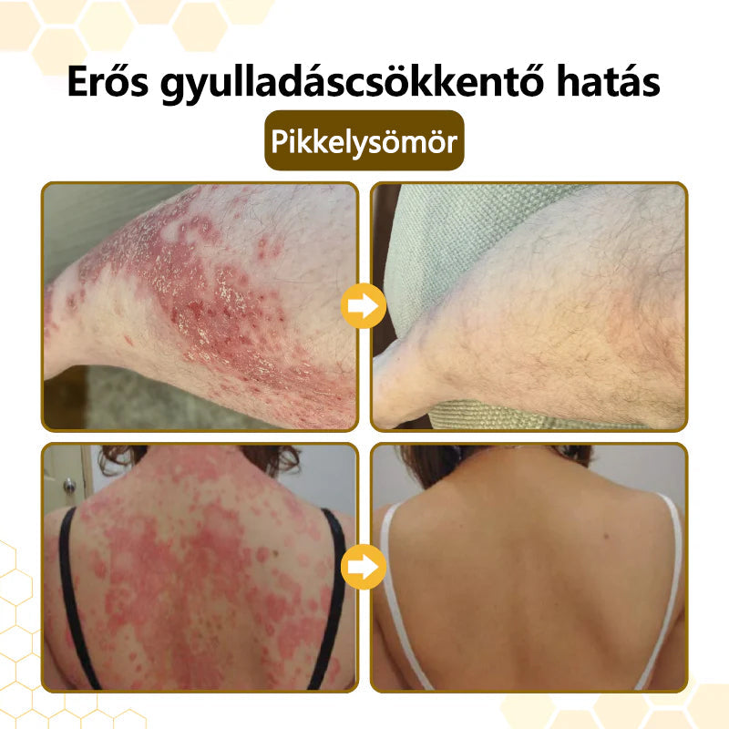 CleraNaure® PsoriaSoothe Méhméreg Bőrregeneráló Krém