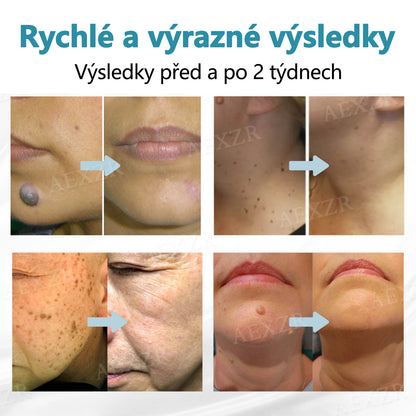 💥💥Foulme® PRO Neinvazivní laserové pero na odstraňování bradavic a znamének💥💥