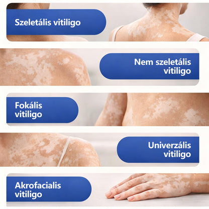 CleraNaure® Piperin Vitiligo újrapigmentáló permet – 🌿Szteroidmentes növényi összetétel | Kíméletes és hatékony minden bőrtípushoz✨