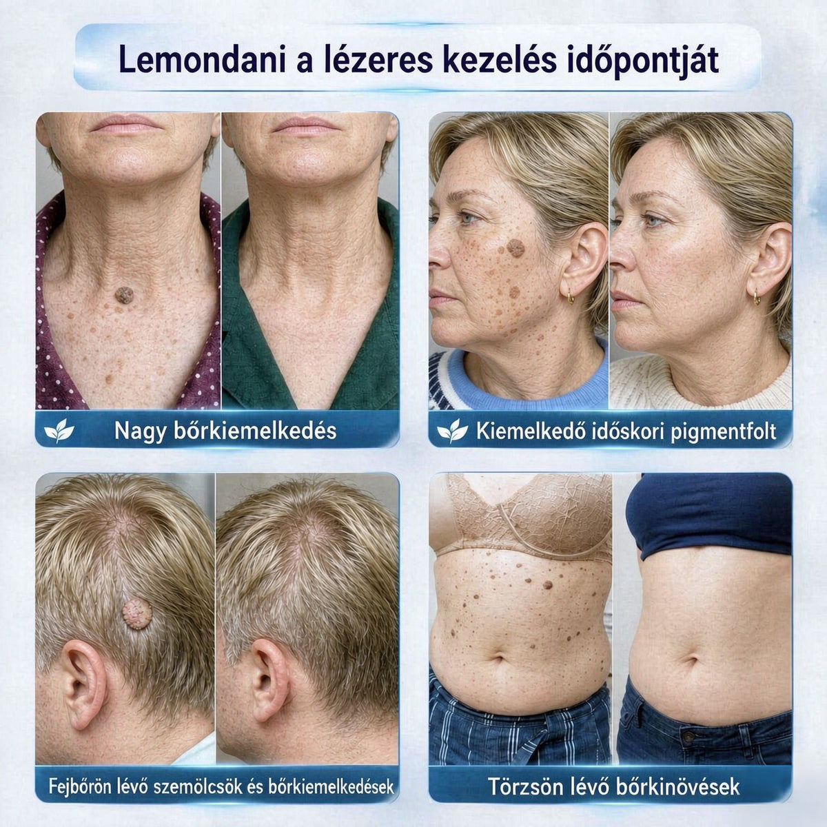 CleraNaure® Bőr Egyenetlenség Finomító Krém｜Segít a zavaró bőrkiemelkedések, anyajegyek és pigmentfoltok kezelésében, kíméletes otthoni bőrápoló krém🌿