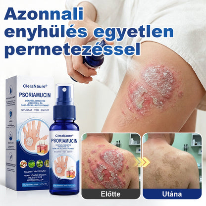 CleraNaure® PsoriaMucin Dörzsölésmentes Viszketés- és Pikkelyenyhítő Permet🥇