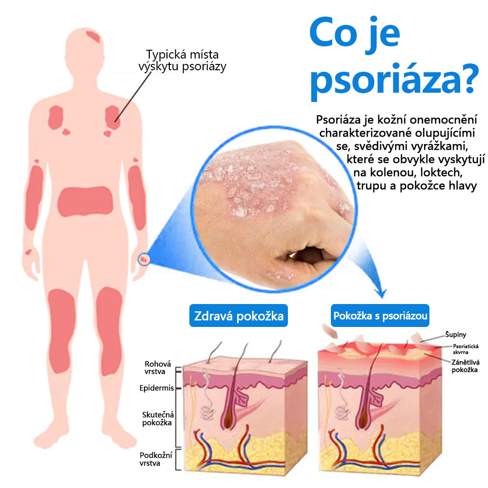 ✅COLTURE® Magnesium bylinný sprej ⚕️ Certifikace MHRA – úleva při psoriáze, ekzému, intimních bakteriálních infekcích, akné a tmavých skvrnách