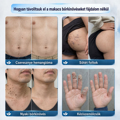 CleraNaure® Bőr Egyenetlenség Finomító Krém｜Segít a zavaró bőrkiemelkedések, anyajegyek és pigmentfoltok kezelésében, kíméletes otthoni bőrápoló krém🌿