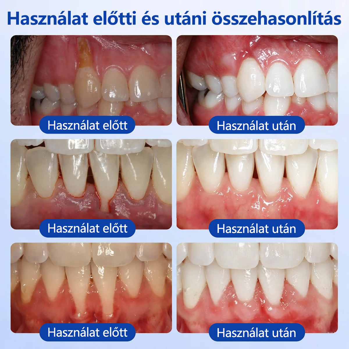 CleraNaure® GumRevive fogágy-szövetregeneráló gél