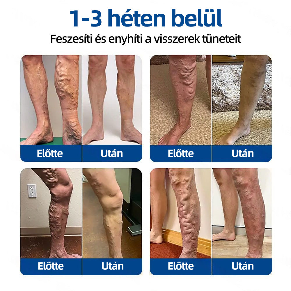 𝐇𝐞𝐚𝐥𝐫𝐢𝐳𝐞®VeinTarget mikrotűs tapasz☑️Azonnali enyhülés hosszú távú eredmények