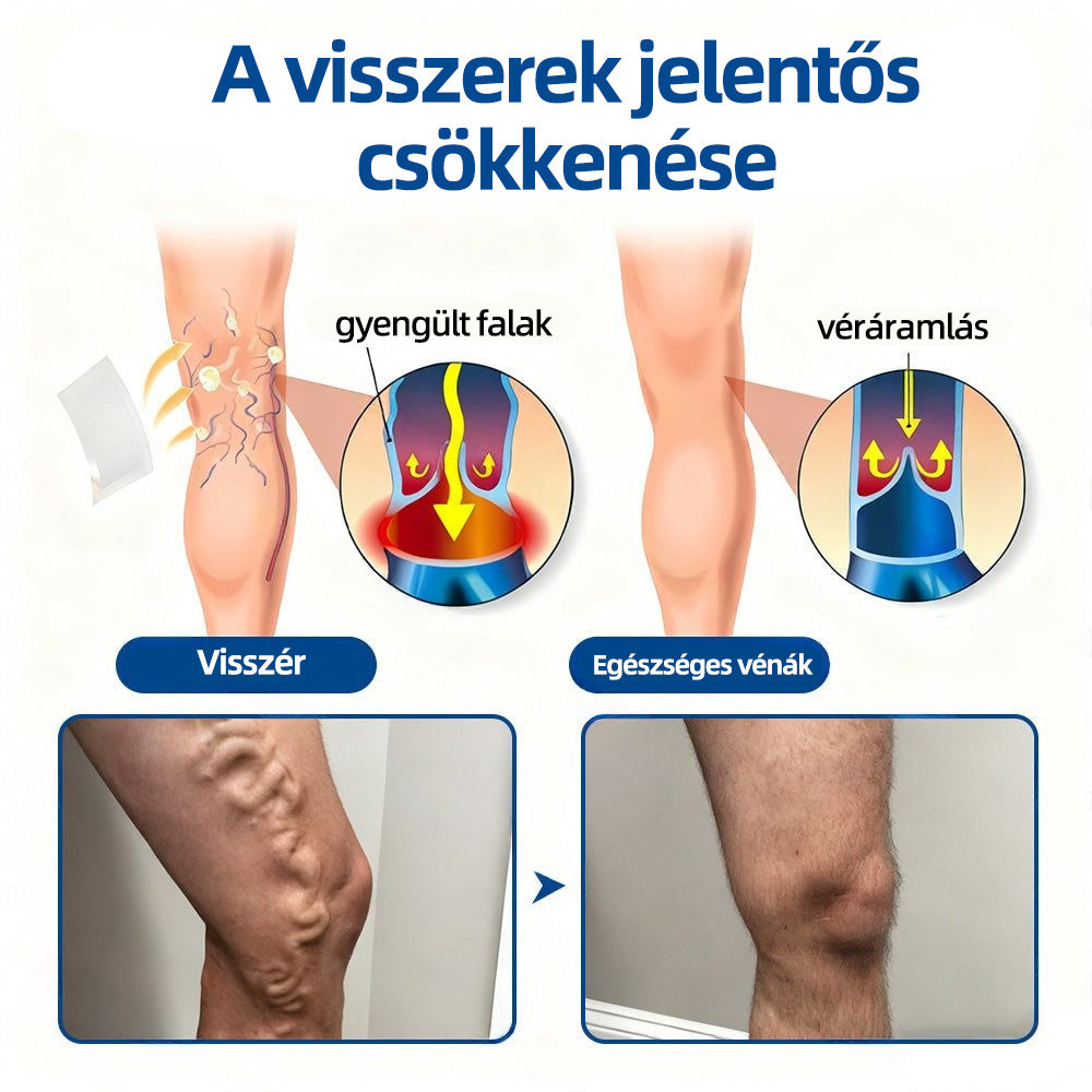𝐇𝐞𝐚𝐥𝐫𝐢𝐳𝐞®VeinTarget mikrotűs tapasz☑️Azonnali enyhülés hosszú távú eredmények
