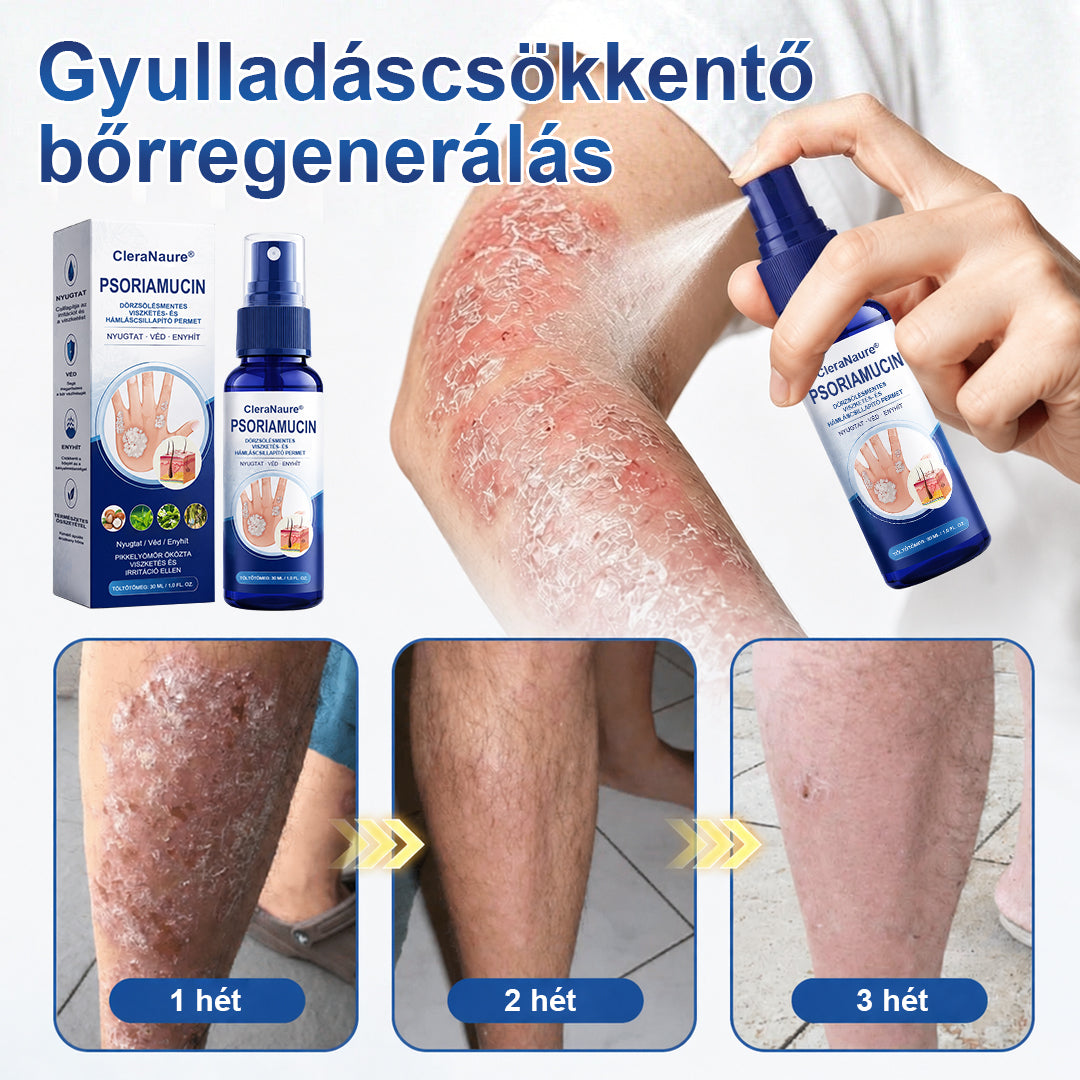 CleraNaure® PsoriaMucin Dörzsölésmentes Viszketés- és Pikkelyenyhítő Permet🥇