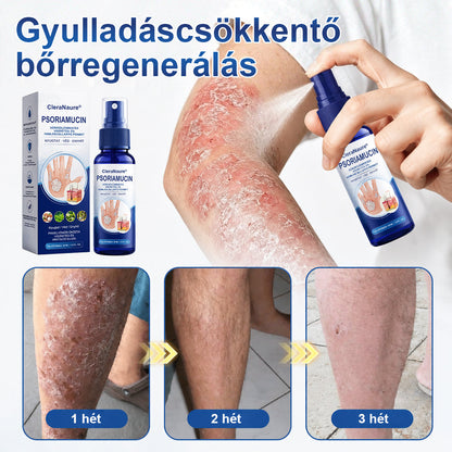CleraNaure® PsoriaMucin Dörzsölésmentes Viszketés- és Pikkelyenyhítő Permet🥇