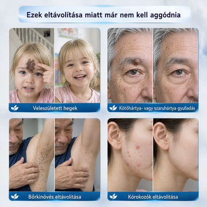 CleraNaure® Bőr Egyenetlenség Finomító Krém｜Segít a zavaró bőrkiemelkedések, anyajegyek és pigmentfoltok kezelésében, kíméletes otthoni bőrápoló krém🌿