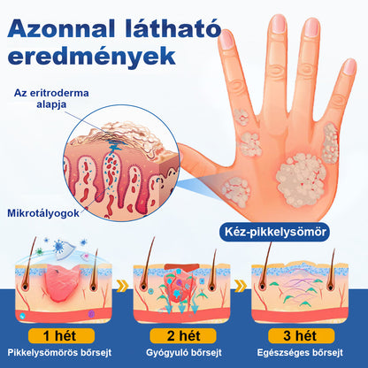 CleraNaure® PsoriaMucin Dörzsölésmentes Viszketés- és Pikkelyenyhítő Permet🥇