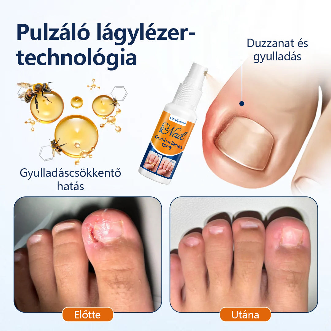 CleraNaure® körömgomba‑könnyítő spray