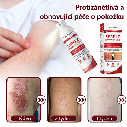 CleraNature® Sprej s Hovězím Tvarohem pro Svědící, Olupující se Pokožku Při Psoriáze