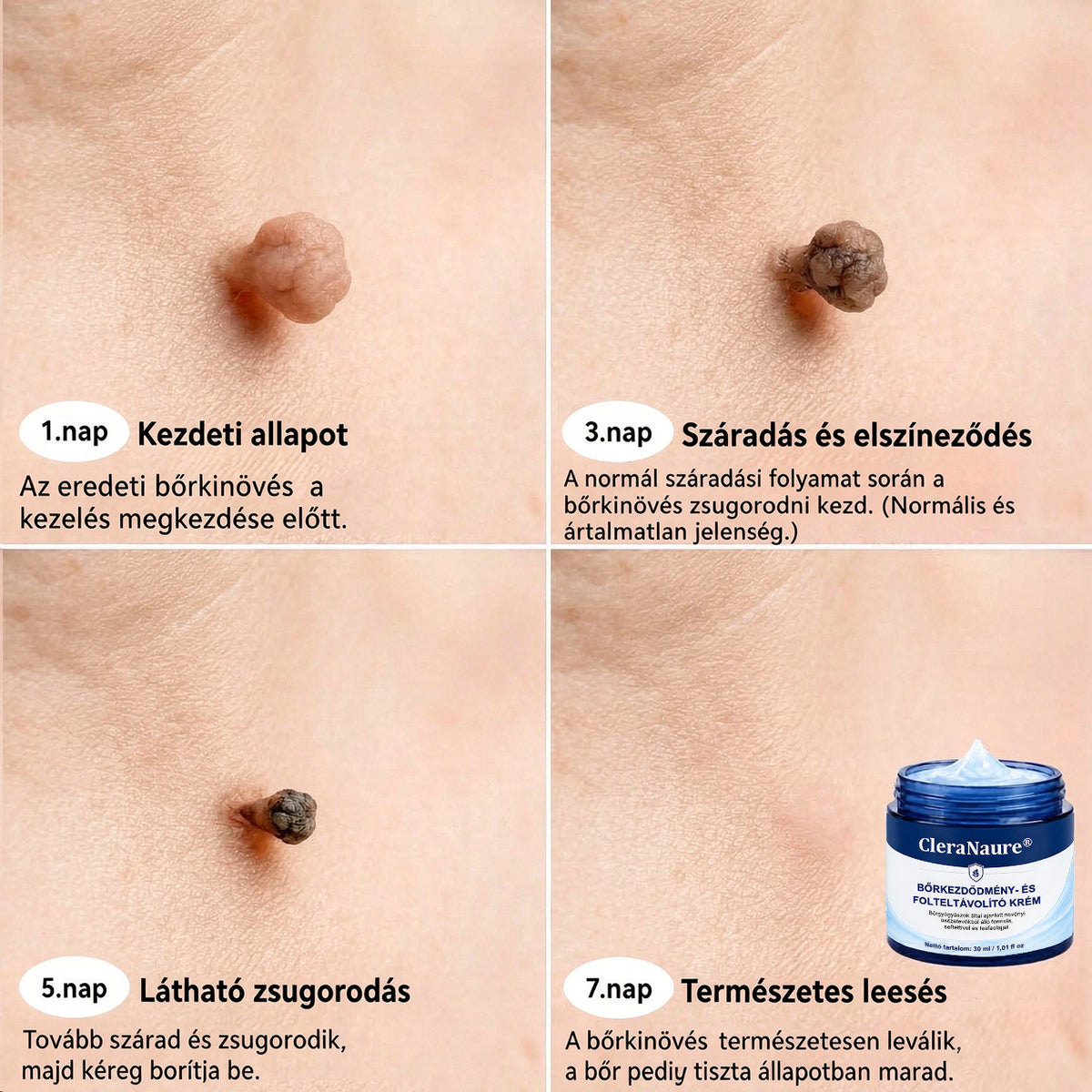 CleraNaure® Bőr Egyenetlenség Finomító Krém｜Segít a zavaró bőrkiemelkedések, anyajegyek és pigmentfoltok kezelésében, kíméletes otthoni bőrápoló krém🌿
