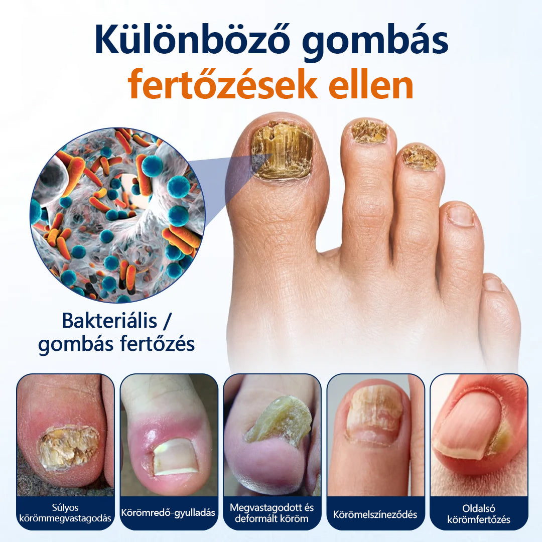 CleraNaure® körömgomba‑könnyítő spray