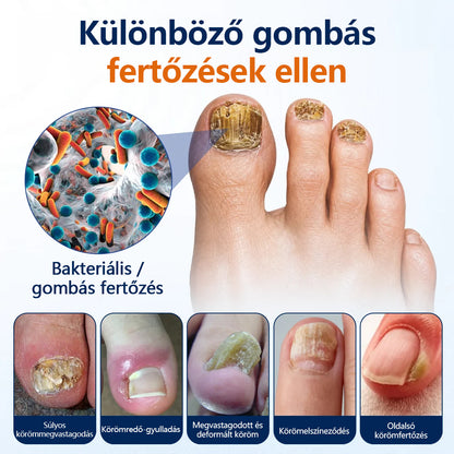 CleraNaure® körömgomba‑könnyítő spray