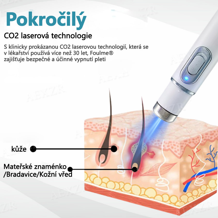 💥💥Foulme® PRO Neinvazivní laserové pero na odstraňování bradavic a znamének💥💥
